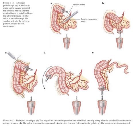widely patent colocolonic anastomosis